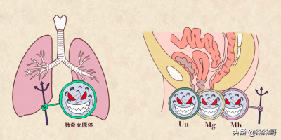 ​支原体阳性感染症状 支原体阳性是感染的意思吗