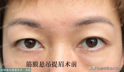​49岁女士做提眉手术，术前，术后恢复过程，术后13天高清对比