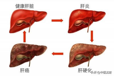 ​肝不好应该吃什么药最好（肝不好，命就不好，送你6个治慢性肝炎的中成药，辩