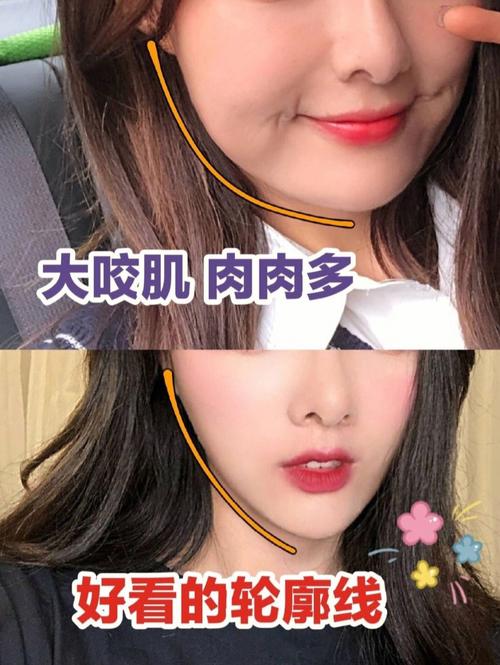 消除咬肌最有效的方法（这4个方法让咬肌小一倍）