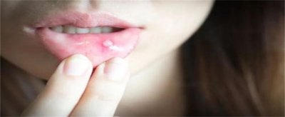 ​口腔溃疡疼痛难忍怎么快速缓解？