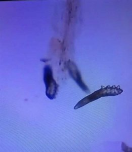 ​女孩睫毛长58只螨虫（武汉女子角膜穿孔，睫毛根部58只蠕形螨，螨虫为什么会进