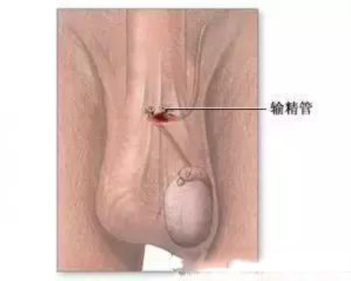 结扎了还能不能恢复生育能力（你还能恢复生育）