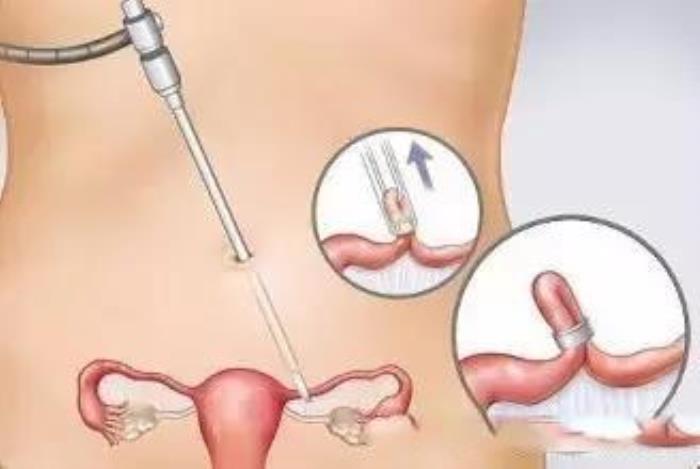 结扎了还能不能恢复生育能力（你还能恢复生育）